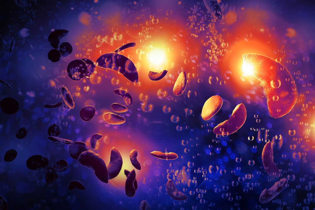 Sickle Cell Anemia