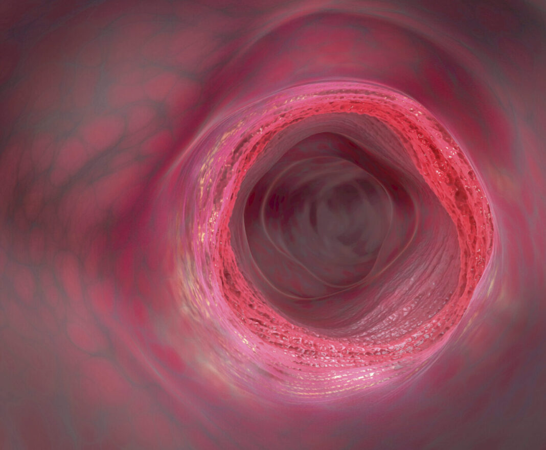 Inflammatory bowel disease, illustration