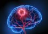 Ultrasound Microbubbles Aid Delivery of Chemotherapy and Immunotherapy in Glioblastoma Patients
