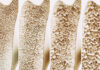 Bone-Enhancing Peptide Shows Promise as Therapeutic for Osteoporosis and MSK Disorders
