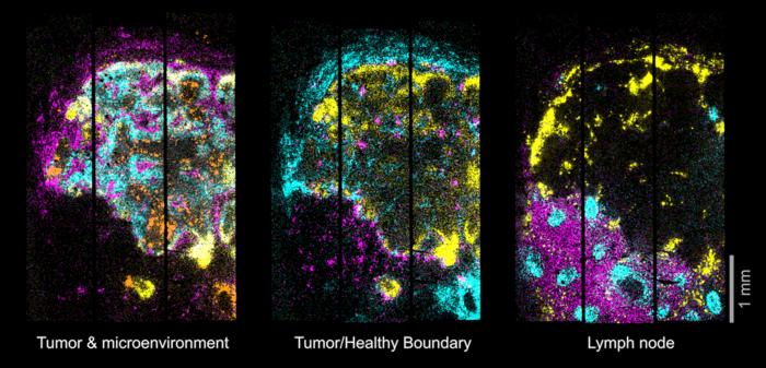 2D map of gene expression in the metastatic lymph node.