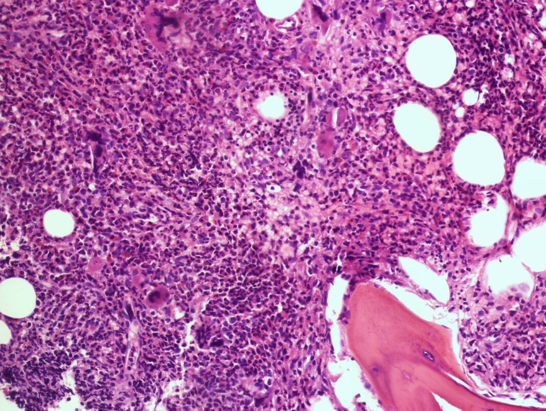 Image of a myelofibrosis stain from Vall d’Hebron University Hospital in Barcelona, Spain