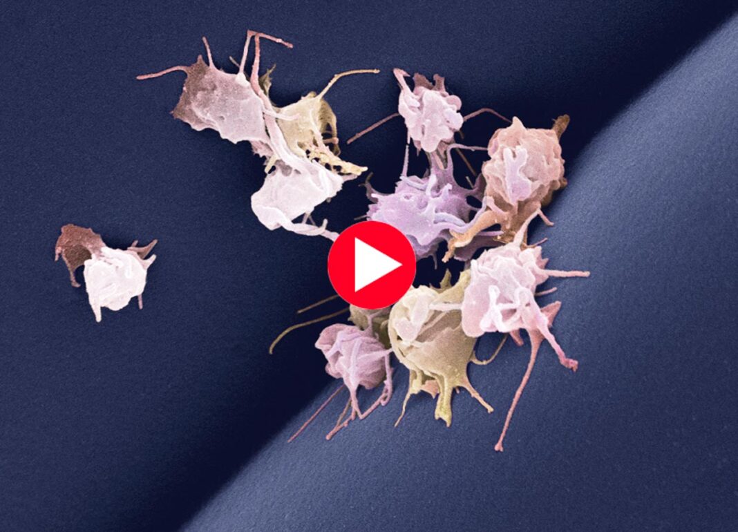 Activated platelets, colored scanning electron micrograph (SEM)